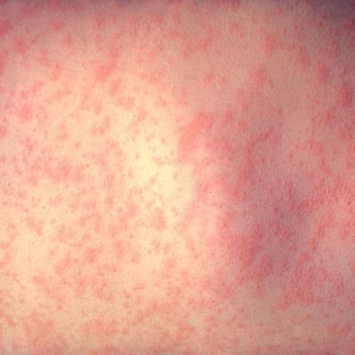 Clinton County Health Department Reminds Residents to Take Caution Against Measles